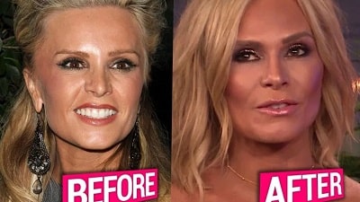 A picture of Tamra Judge before (left) and after (right) plastic surgeries.